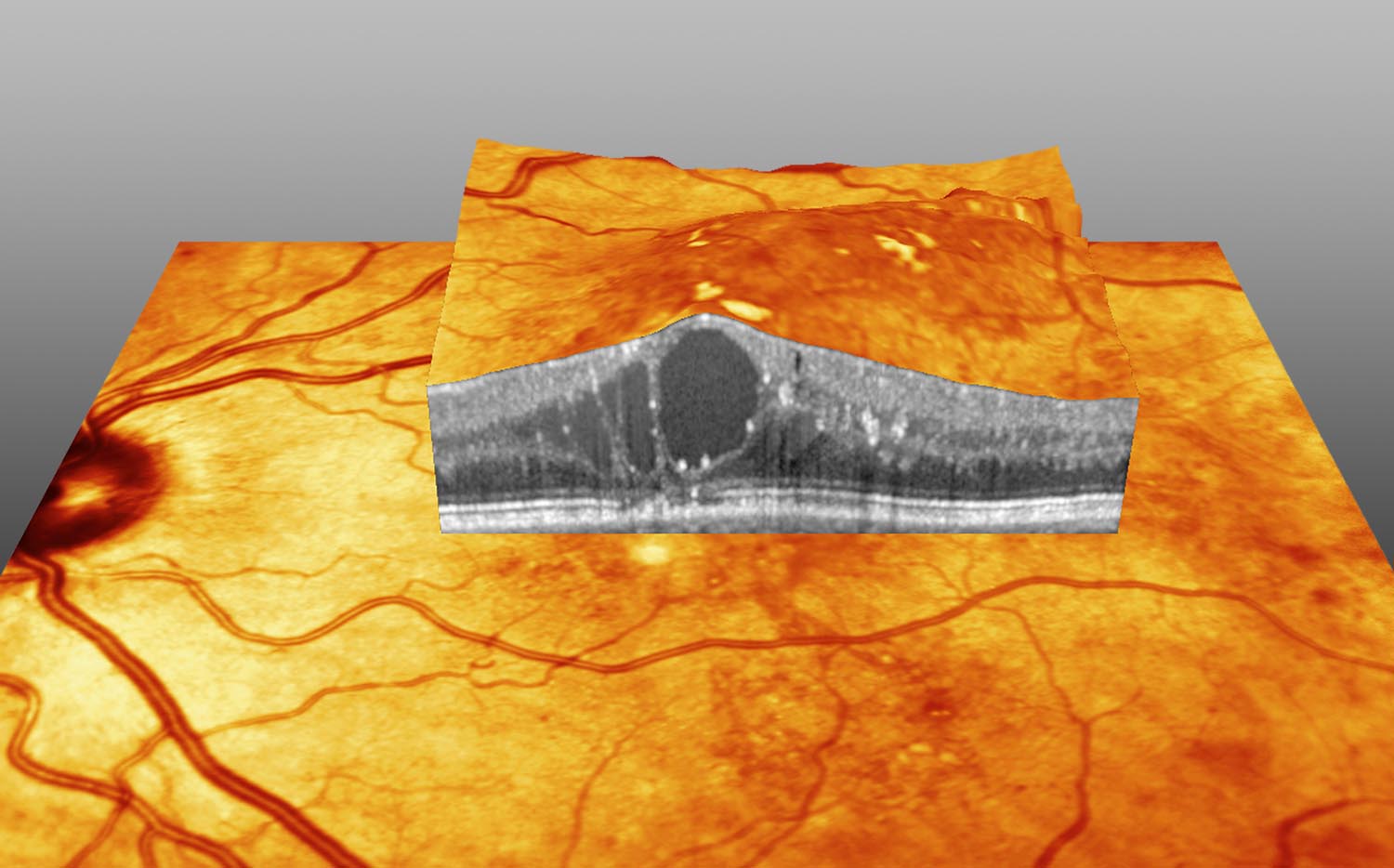 Makulaödem bei Diabetes